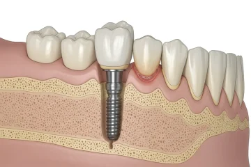 Dental Implant